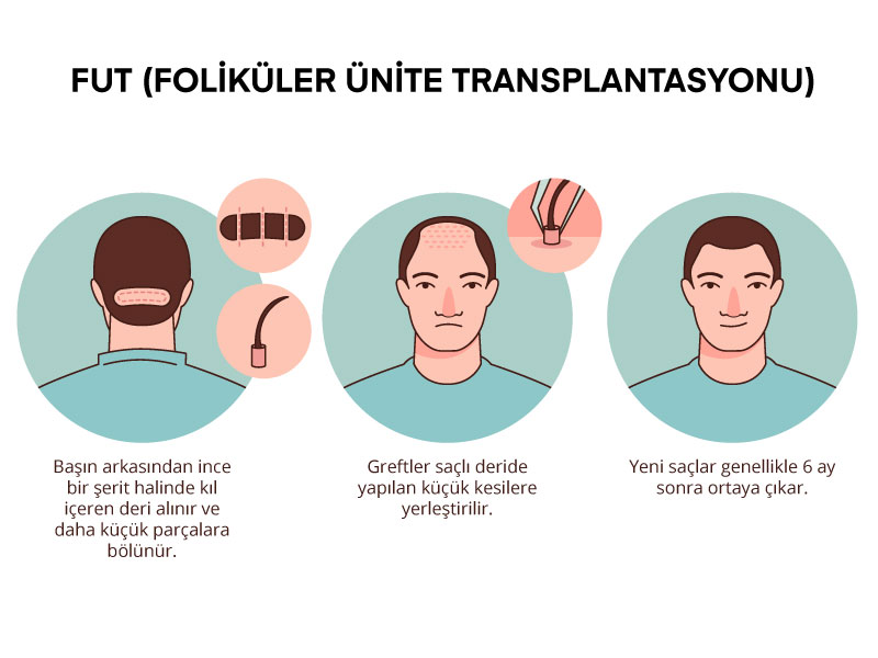 FUT (Foliküler Ünite Transplantasyonu)